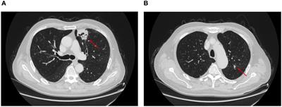 Primary squamous cell carcinoma and adenocarcinoma simultaneously occurring in the same lung lobe: a case report and literature review